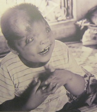 Agent-Orange-Opfer Do Duc Duyen: Der 8 Jahre alte Do Duc Duyen nach dem Frühstück, er macht Witze mit seiner Mutter Huong. Duyens Lebensmut hat es seinen Eltern ermöglicht, ihre Schwierigkeiten zu überwinden, und er er gibt ihnen weiterhin Stärke durch seine Lebenslust. Foto: Doan Duc Minh Agent-Orange-Opfer Do Duc Duyen: Der 8 Jahre alte Do Duc Duyen nach dem Frühstück, er macht Witze mit seiner Mutter Huong. Duyens Lebensmut hat es seinen Eltern ermöglicht, ihre Schwierigkeiten zu überwinden, und er er gibt ihnen weiterhin Stärke durch seine Lebenslust. Foto: Doan Duc Minh