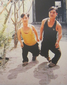 Zwei Agent-Orange-Opfer, die Brder Nguyen Ngoc Diep und Nguyen Thanh Tung: Die Brder Nguyen Ngoc Diep und Nguyen Thanh Tung aus der Gemeinde Kim Long, Distrikt Tam Duong, Provinz Vinh Phuc [beide Brder sind durch verformte und viel zu kurze Beine etwas gehbehindert]