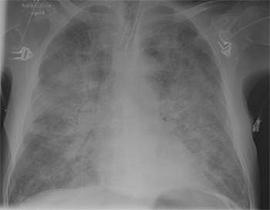 Foto radiográfica de un edema pulmonar Foto radiográfica de un edema pulmonar