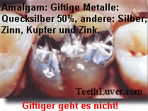 Amalgam-Zahn: Die Legierung besteht aus
Quecksilber (50%), die anderen Anteile aus Silber,
Zinn, Kupfer und Zink. Giftiger geht es nicht! Amalgam-Zahn: Die Legierung besteht aus
Quecksilber (50%), die anderen Anteile aus Silber,
Zinn, Kupfer und Zink. Giftiger geht es nicht!