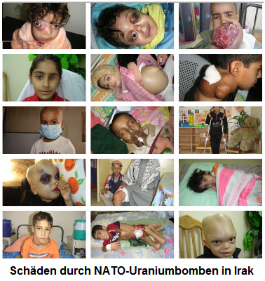 Deformierte Menschen durch
                          NATO-Uraniumbomben im Irak