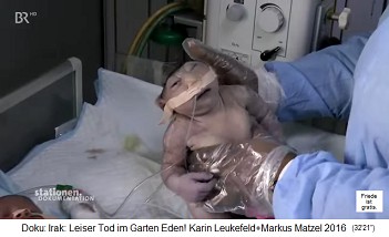 Basra (Irak), das Kinderkrankenhaut mit Fr�hgeburt mit einem offenen Hirn